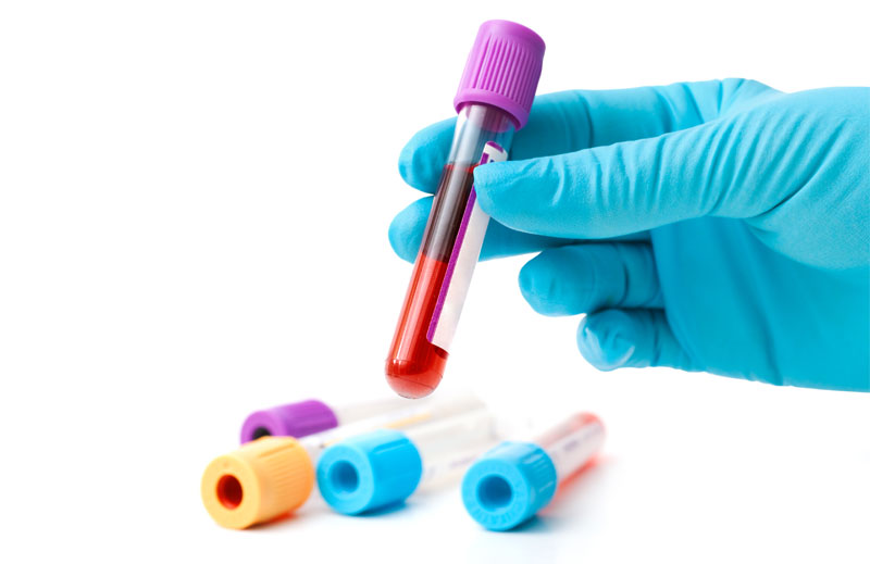 Low Testosterone Blood Test