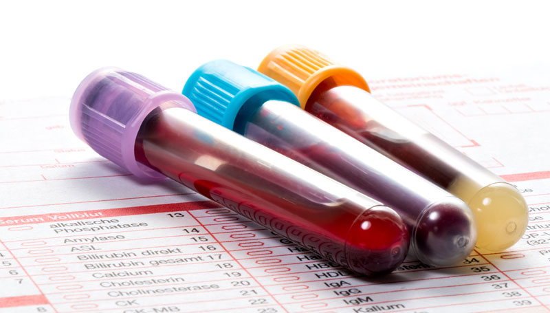 Preparing for a Low Testosterone Blood Test