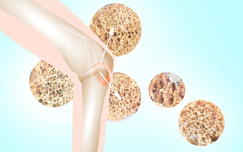 Osteoporosis and Testosterone