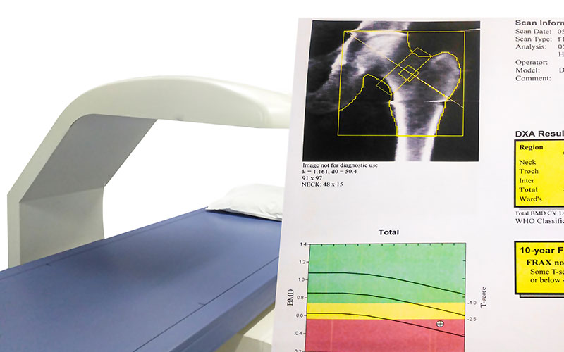 Examination Hip Bone Density