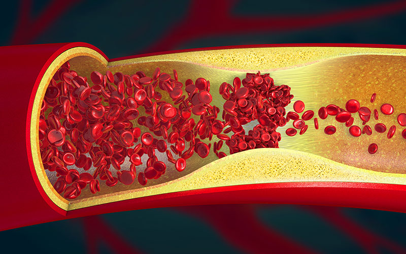 Coronary Artery Disease and Low T
