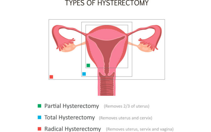 Hysterectomy