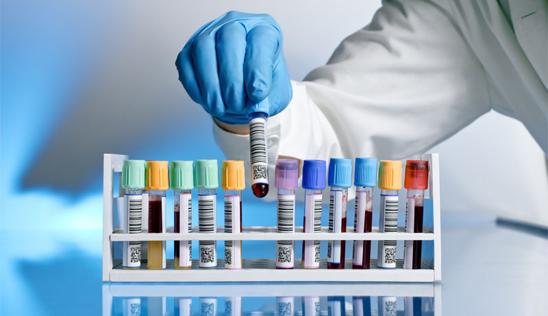 Understanding Your Low Testosterone Blood Test Results